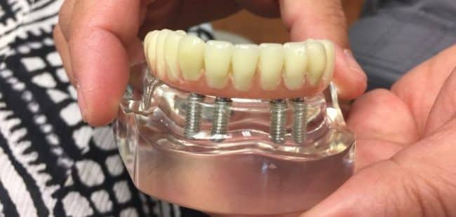 alt="cheap dental implants"